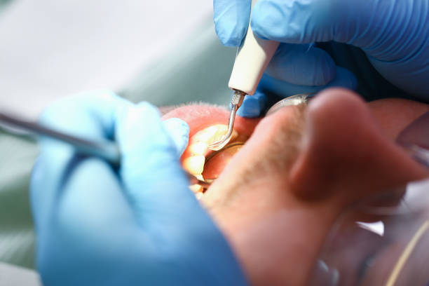 Best Dentist for Tooth Abscess  in Monticello, IA