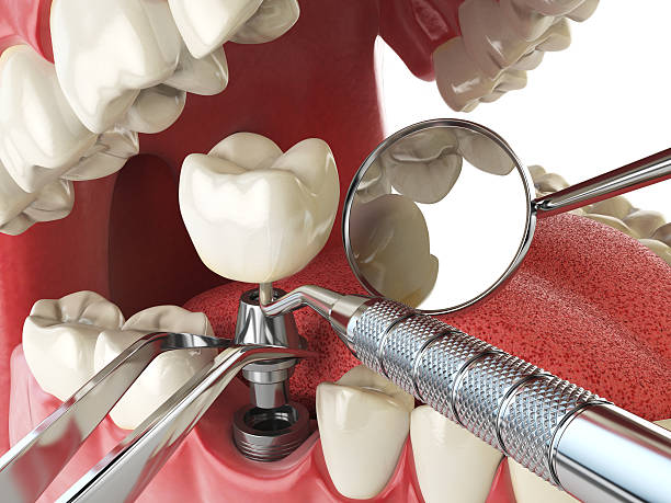 Best Root Canal Emergency Dentist  in Monticello, IA